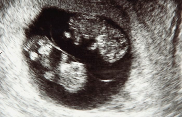 Multiple Pregnancies – High-Risk Pregnancy Multiple Pregnancies - High-Risk Pregnancy