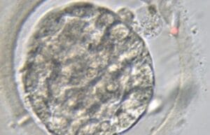 Advanced Fertility Treatments - Assisted Hatching