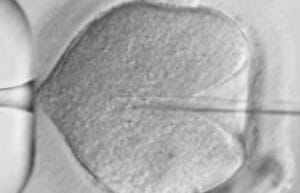 Advanced Fertility Treatments - ICSI